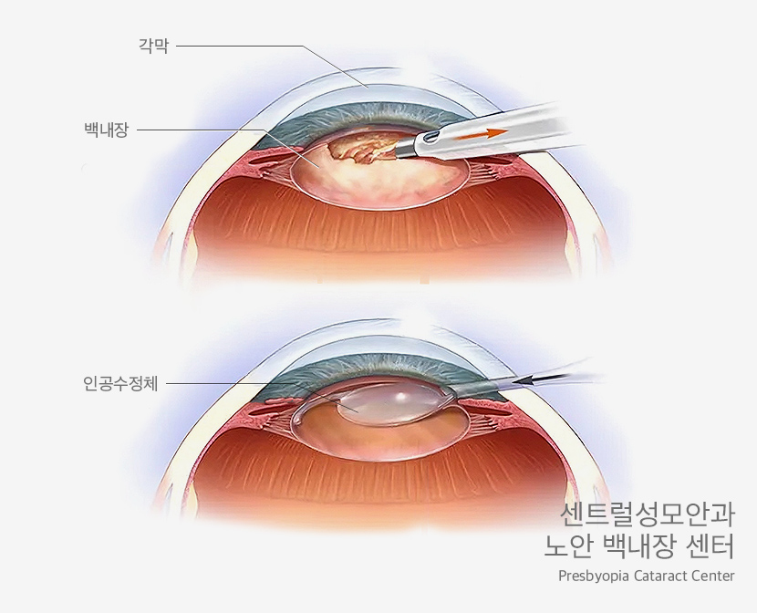 노안 백내장 센터