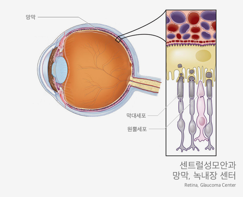 노안 백내장 센터