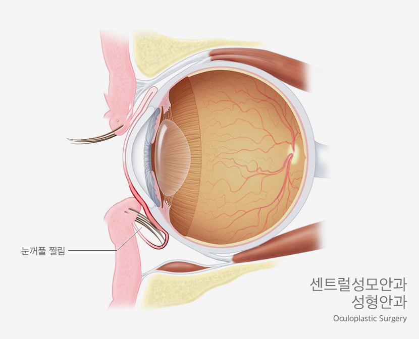노안 백내장 센터