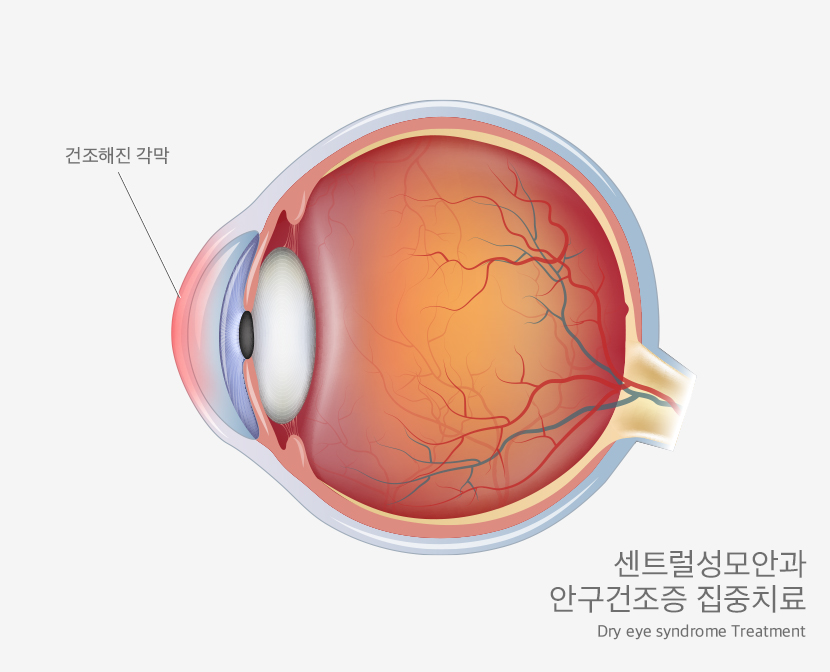 노안 백내장 센터