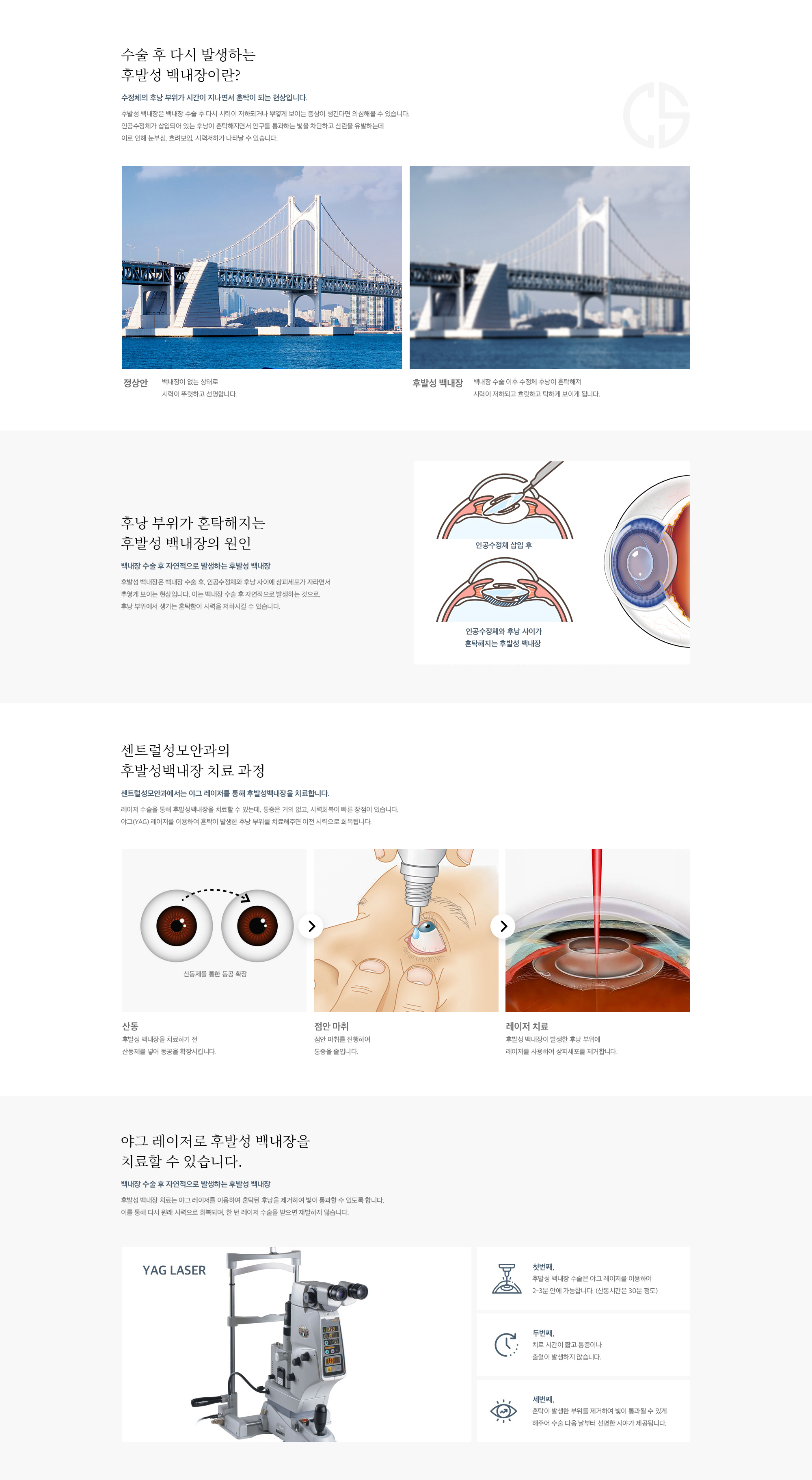 후발성 백내장