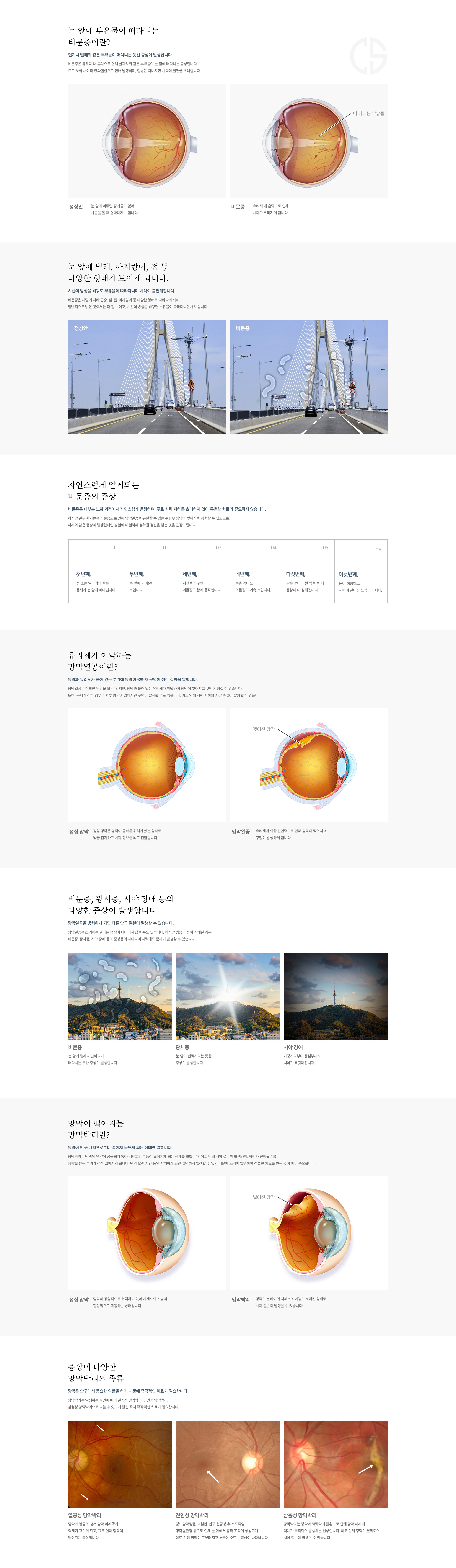 비문증, 망막열공, 망막박리