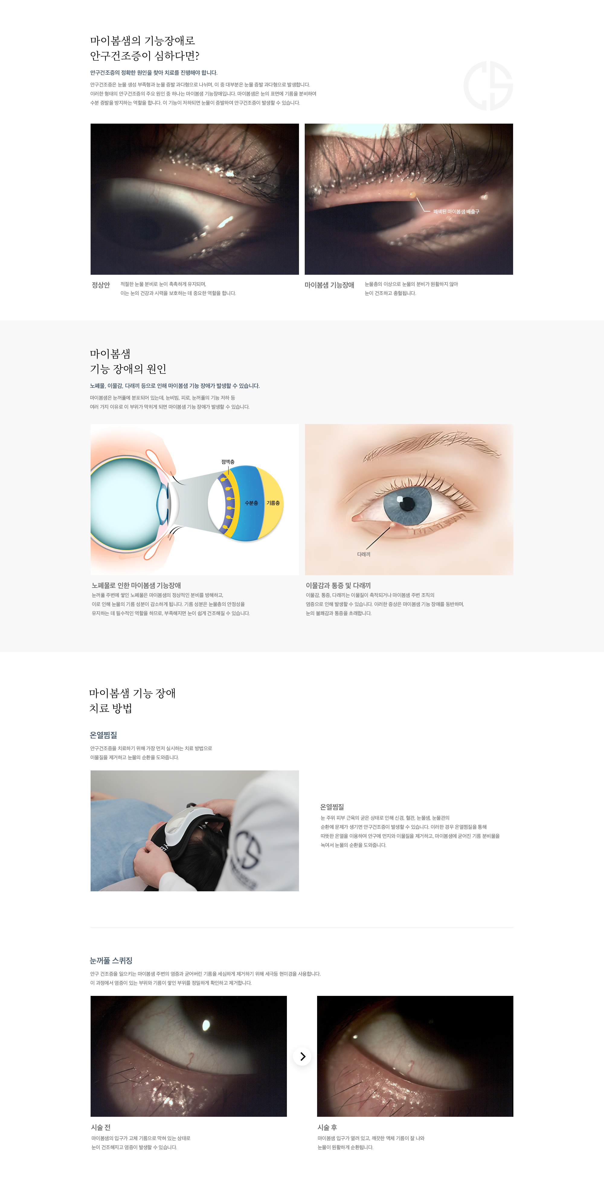 온열찜질/스퀴징